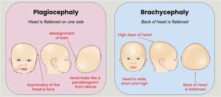 What causes Brachycephaly in babies