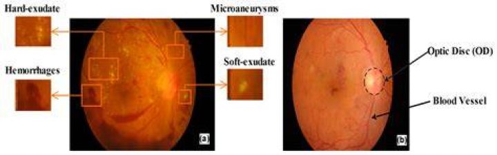 What causes exudates in the eye