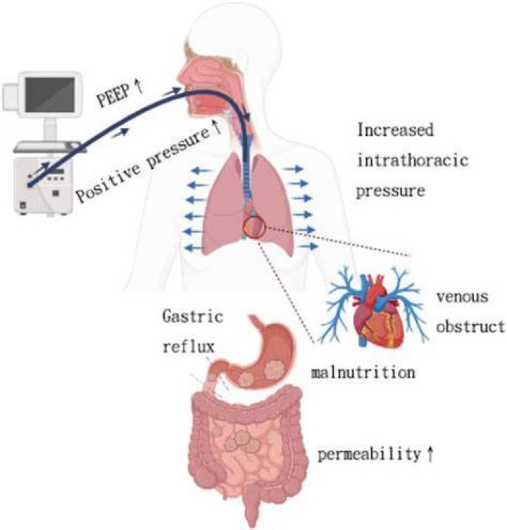 What causes intrathoracic pressure