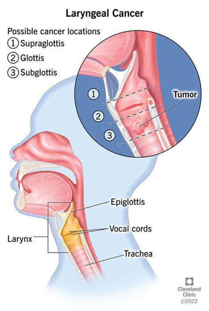What causes laryngeal cleft