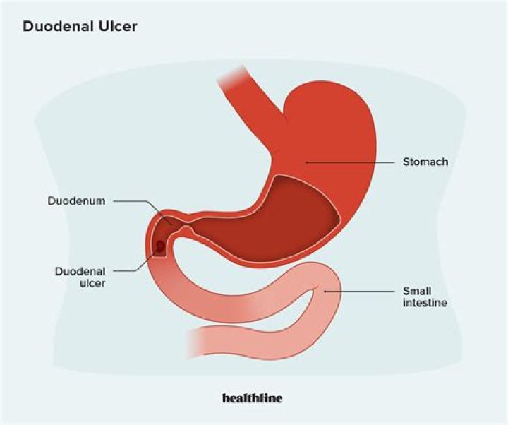 What causes pain in the duodenum