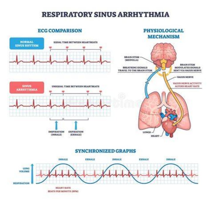 What causes respiratory sinus arrhythmia