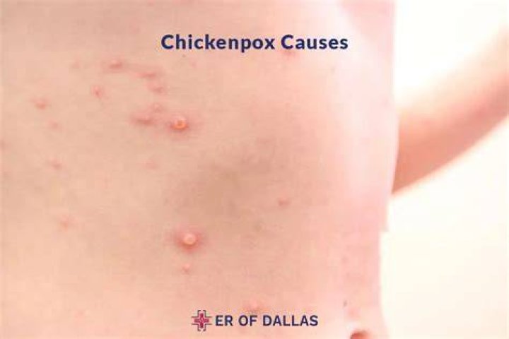 What causes swine pox
