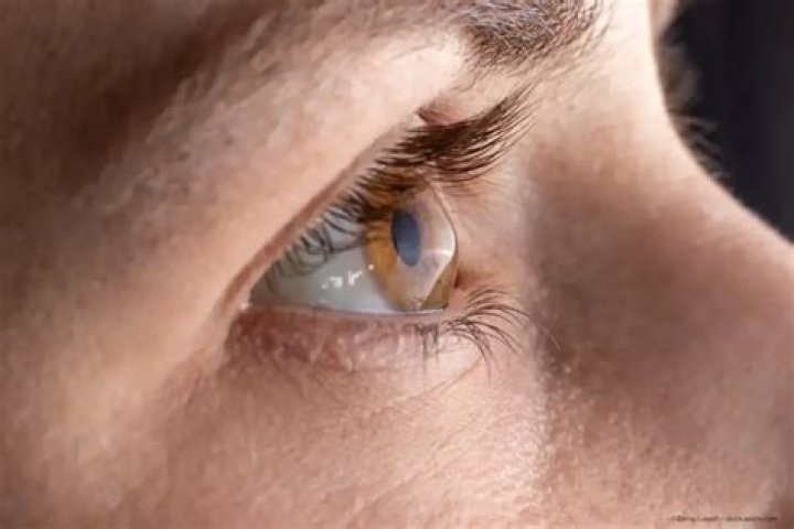 What causes thinning cornea