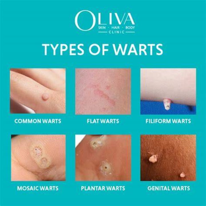 What do flat warts on face look like
