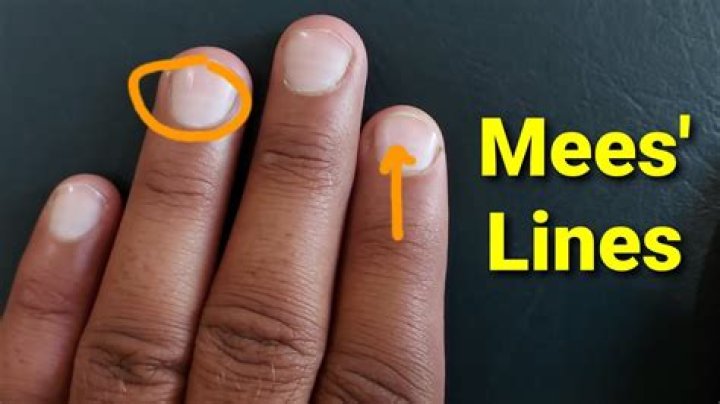 What do Mees lines look like