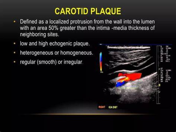 What does a carotid duplex show
