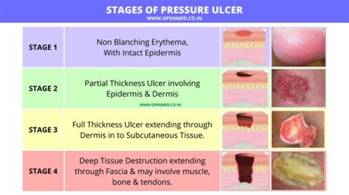 What does a grade 3 pressure sore look like