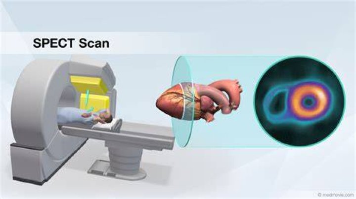 What does a Spect CT scan show