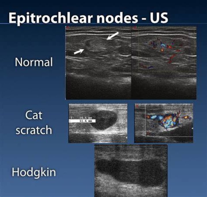 What does an enlarged Epitrochlear lymph node mean