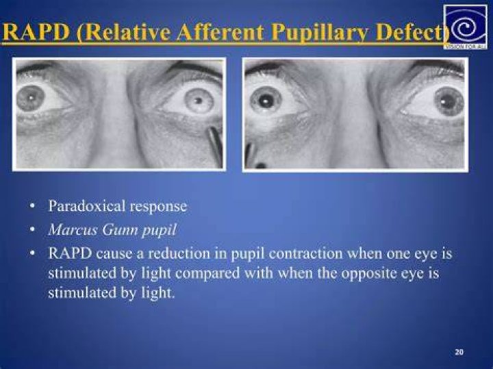 What does APD mean in ophthalmology