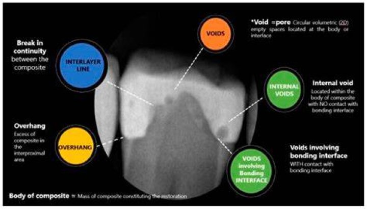 What does apical Radiolucency mean