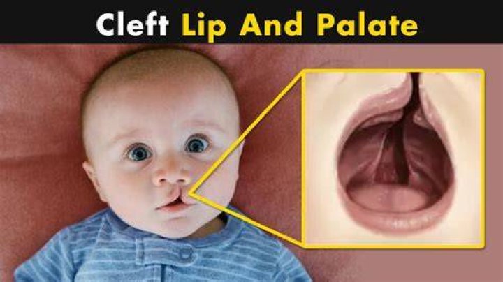 What does cleft lip look like