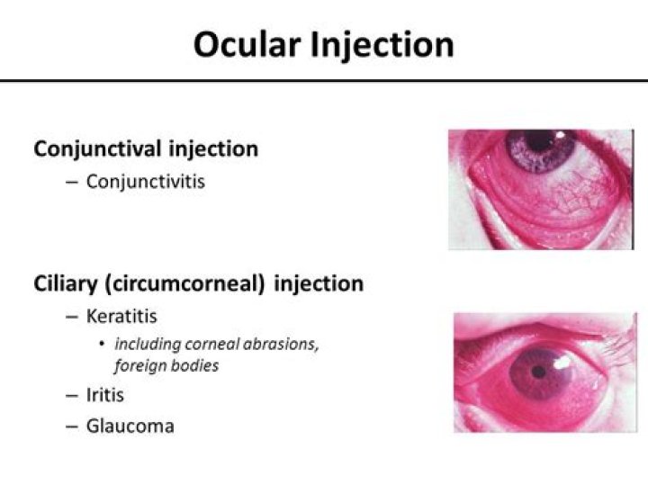 What does conjunctival injection mean