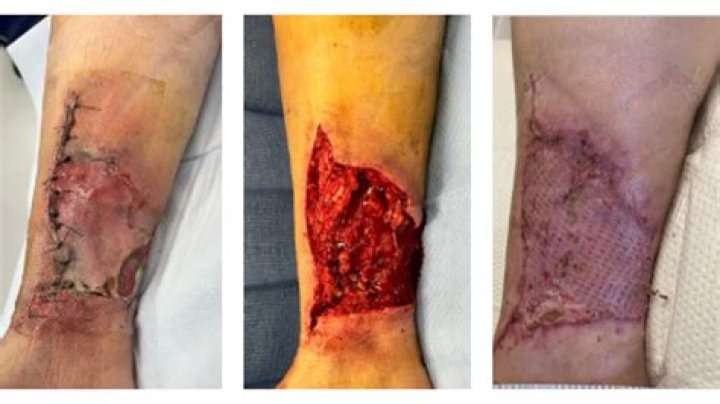 What does it mean when a wound is tunneling