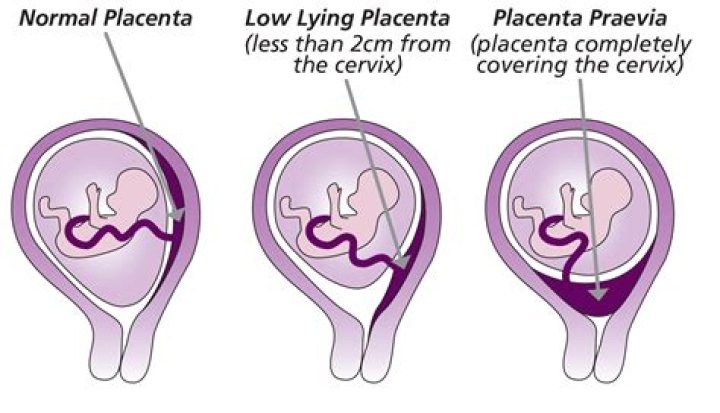 What does weak placenta mean