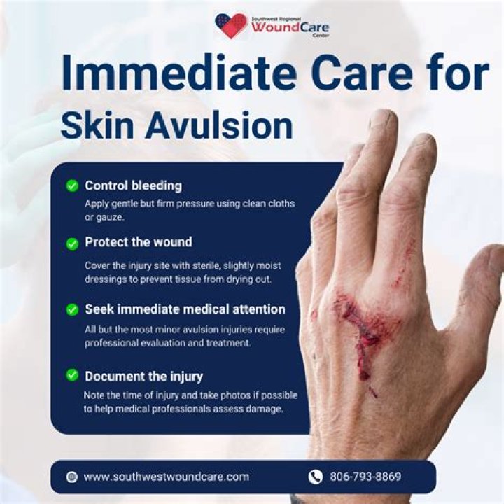 What is a avulsion wound