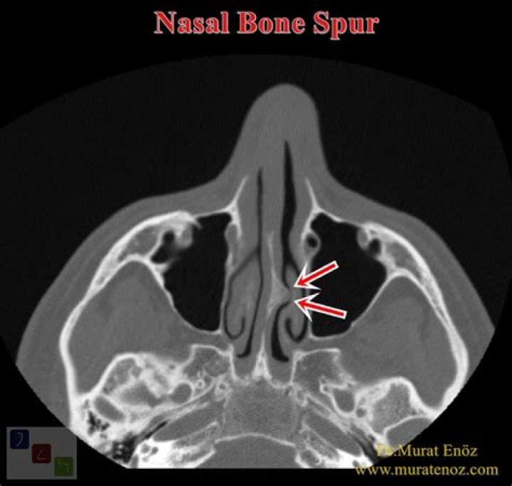 What is a nasal bone spur