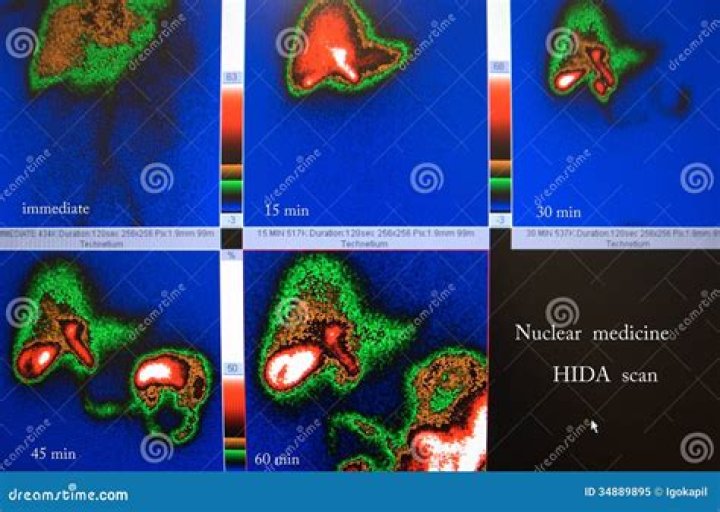 What is a normal ejection fraction on a HIDA scan