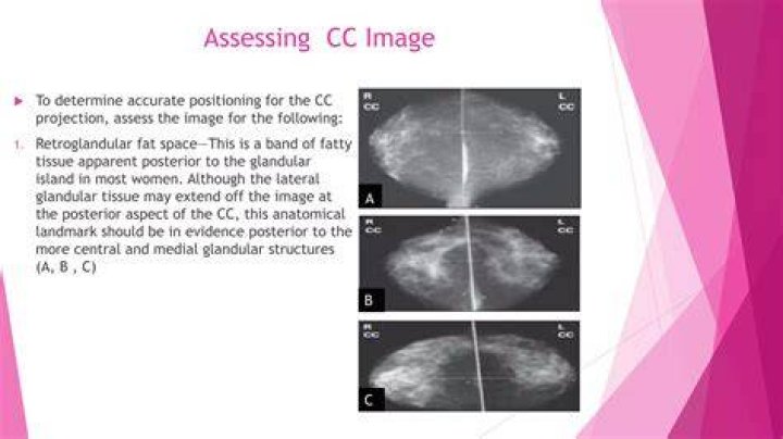 What is a special view mammogram
