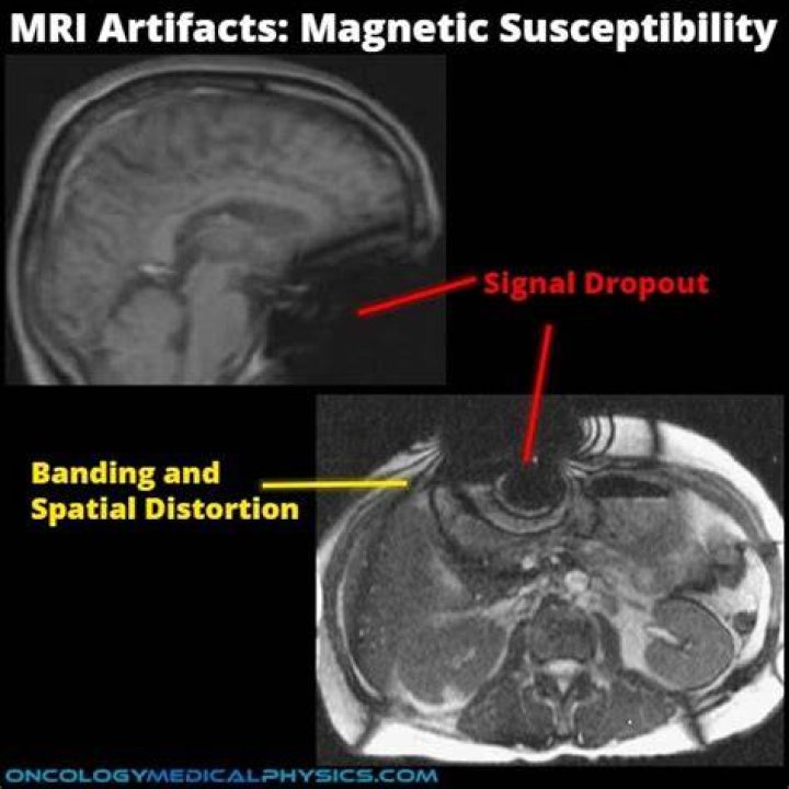 What is a susceptibility artifact