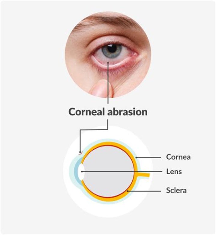 What is a thinning cornea