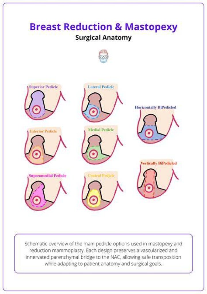 What is a wise pattern mastopexy