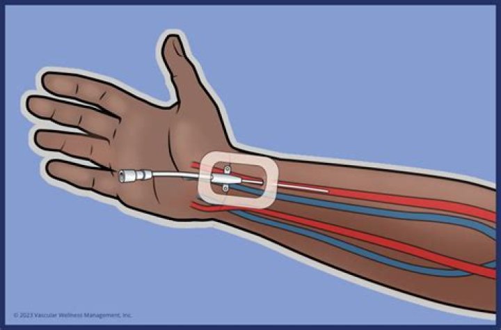 What is arterial line placement