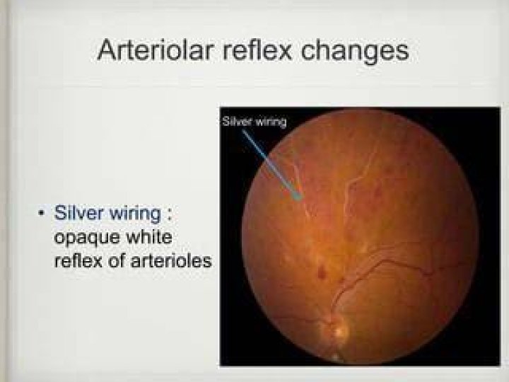What is arteriolar light reflex