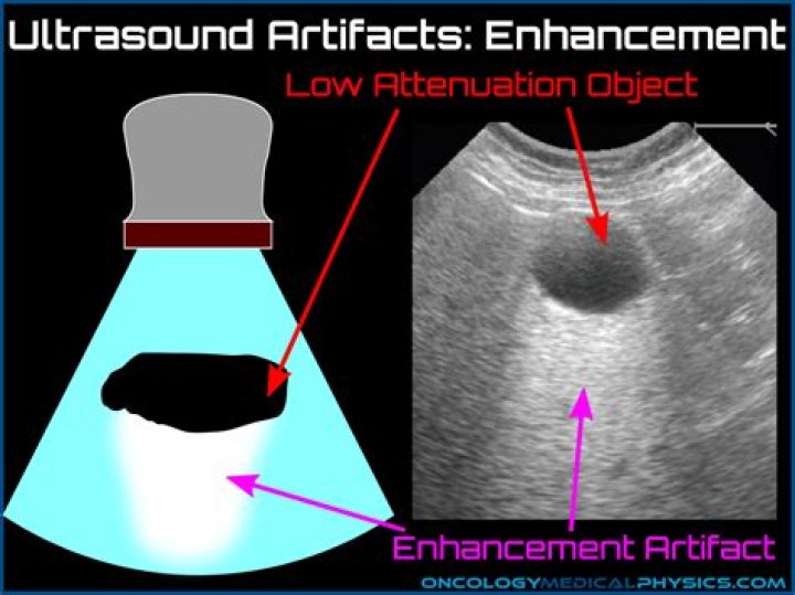 What is attenuation artifact