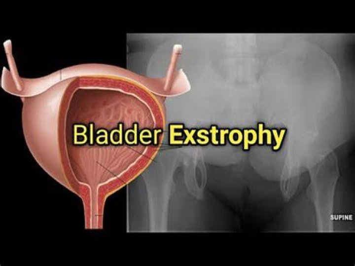 What is bladder exstrophy