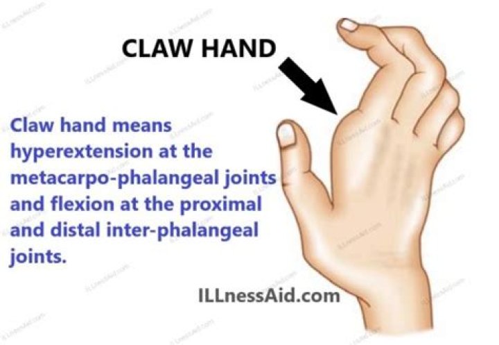 What is claw hand