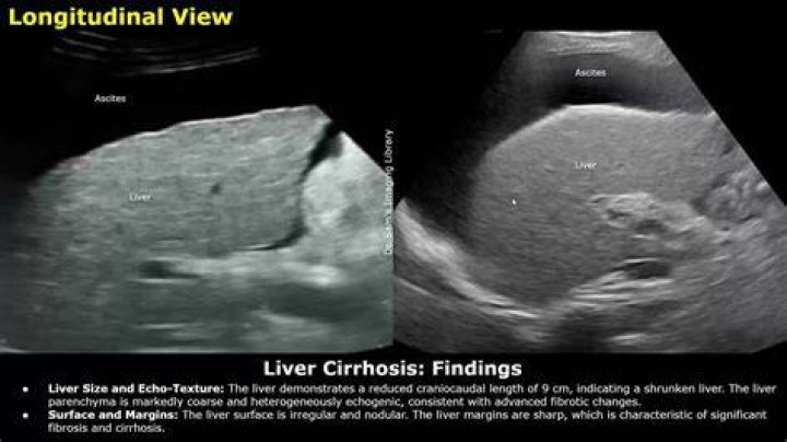 What is coarse hepatic Echotexture