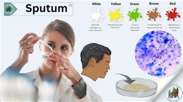 What is copious sputum production