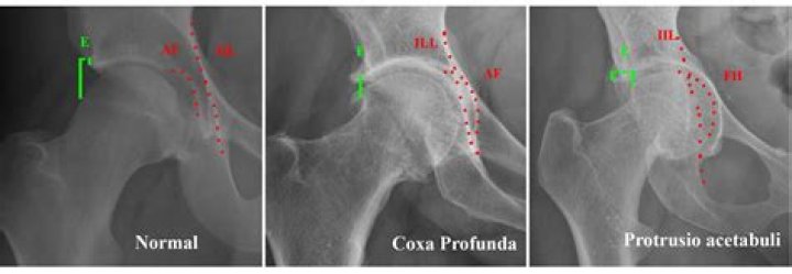What is coxa profunda