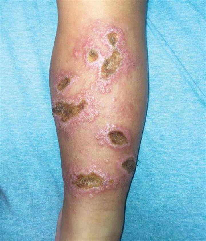 What is cutaneous anthrax