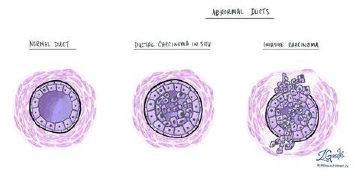 What is DCIS