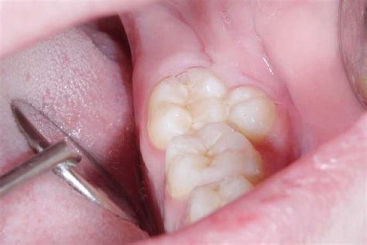 What is Distomolar