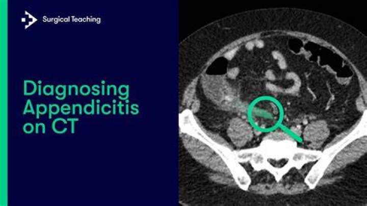 What is imaging for appendicitis