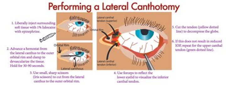 What is lateral Canthotomy