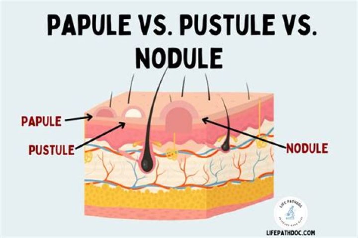 What is Macule and Papule