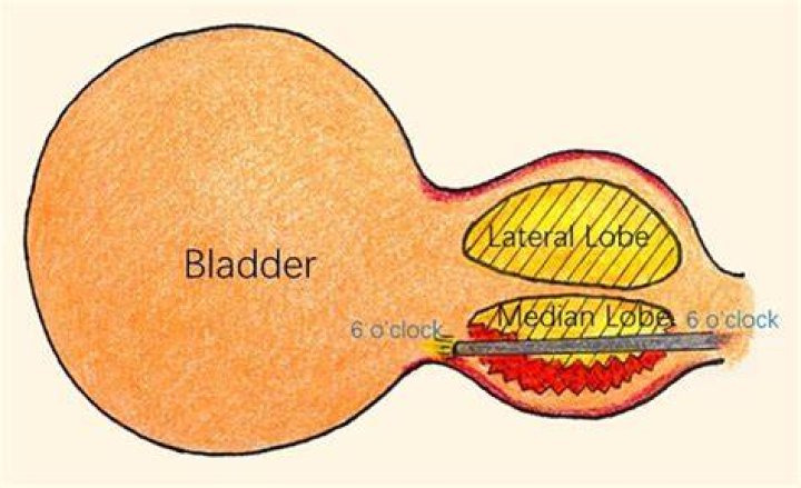 What is median lobe