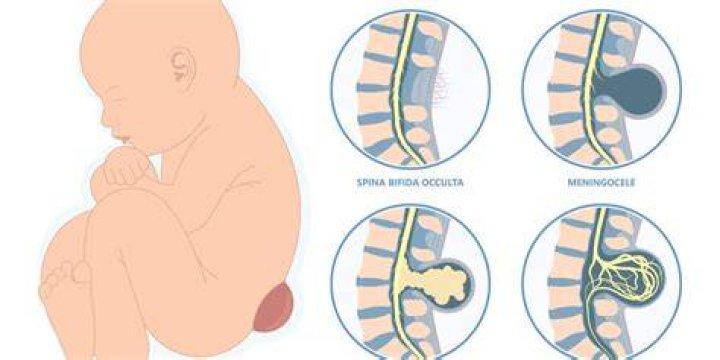 What is Myelocele