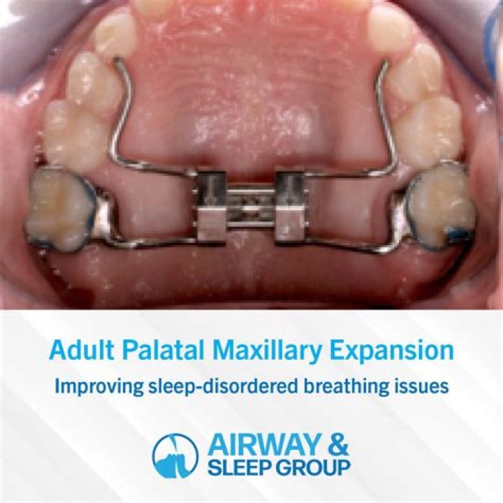 What is palatal palsy