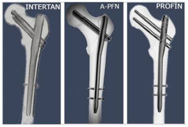 What is PFN surgery