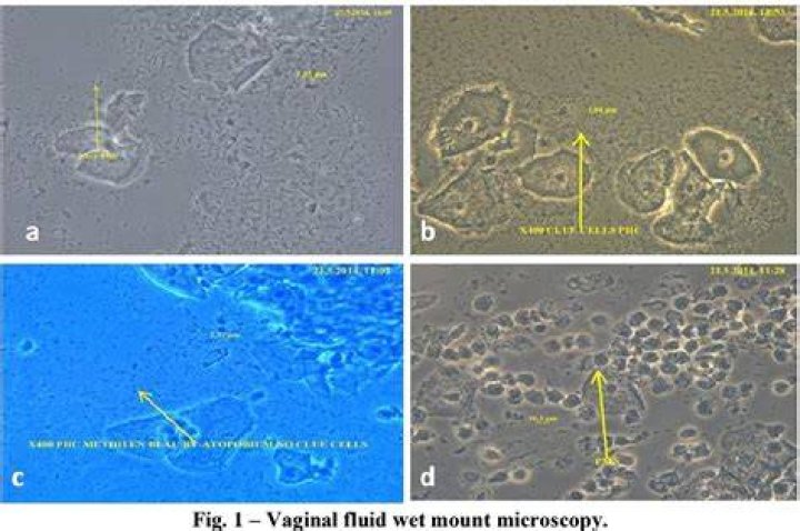 What is PMN on wet prep
