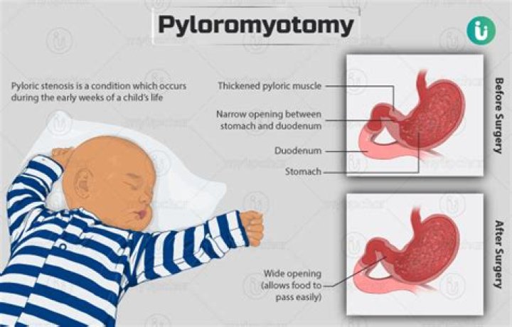 What is Pyloromyotomy surgery