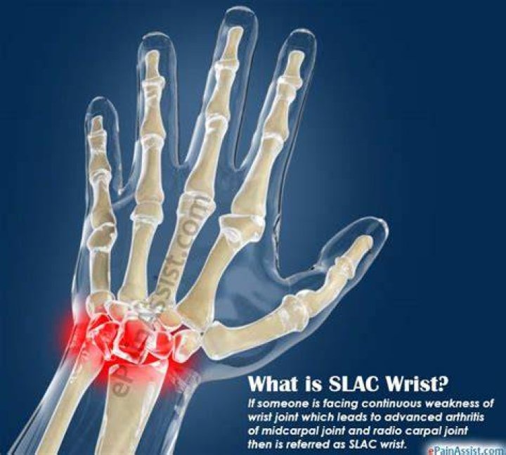 What is SLAC wrist