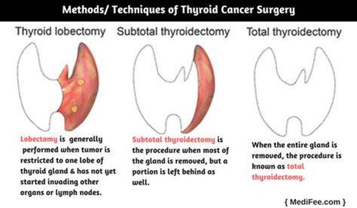 What is subtotal thyroidectomy