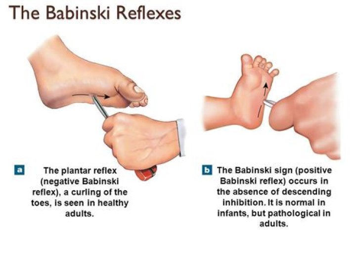 What is the Babkin reflex